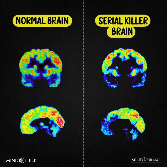 Normal Brain Serial Killer Brain