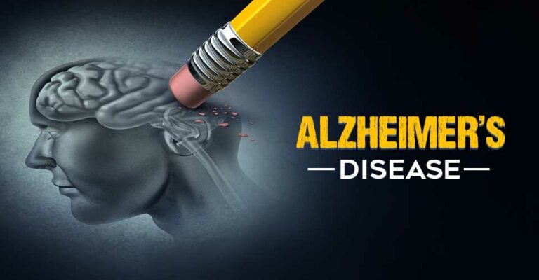 Alzheimer’s Disease